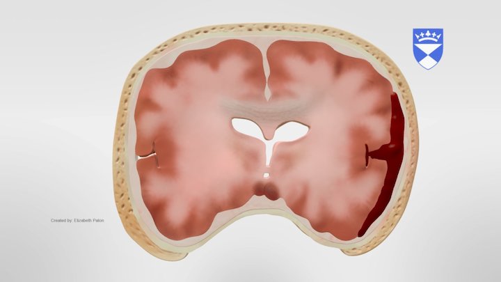 Subdural Haematoma 3D Model
